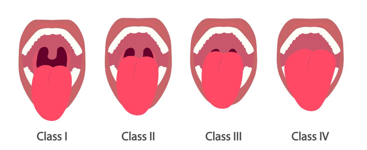 Mallampati Score